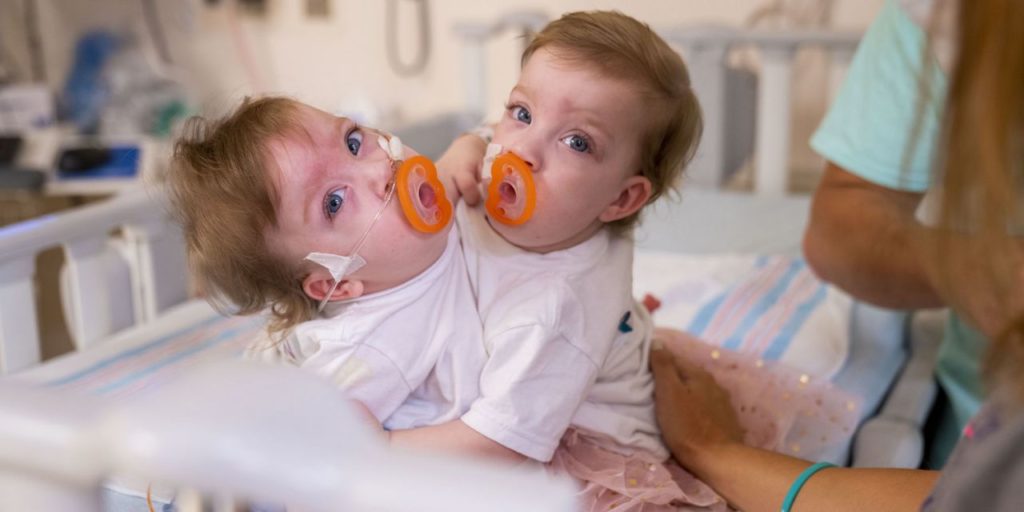 Nonpartisan News without politics Non political 
News without politics Unbiased 
Rare conjoined twins, born locked in embrace, successfully separated in Michigan