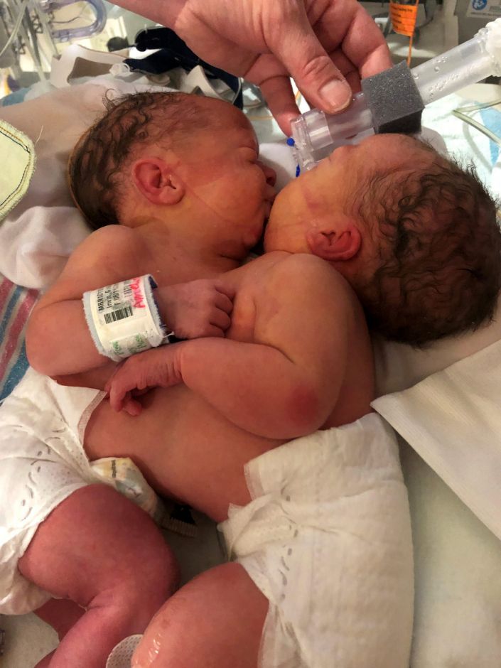 Conjoined twins are successfully separated after being locked in embrace non-political 
News without politics totally unbiased news
