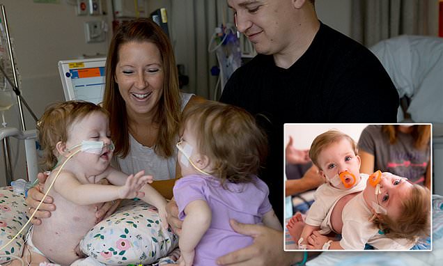 Rare conjoined twins, born locked in embrace, successfully separated in Michigan