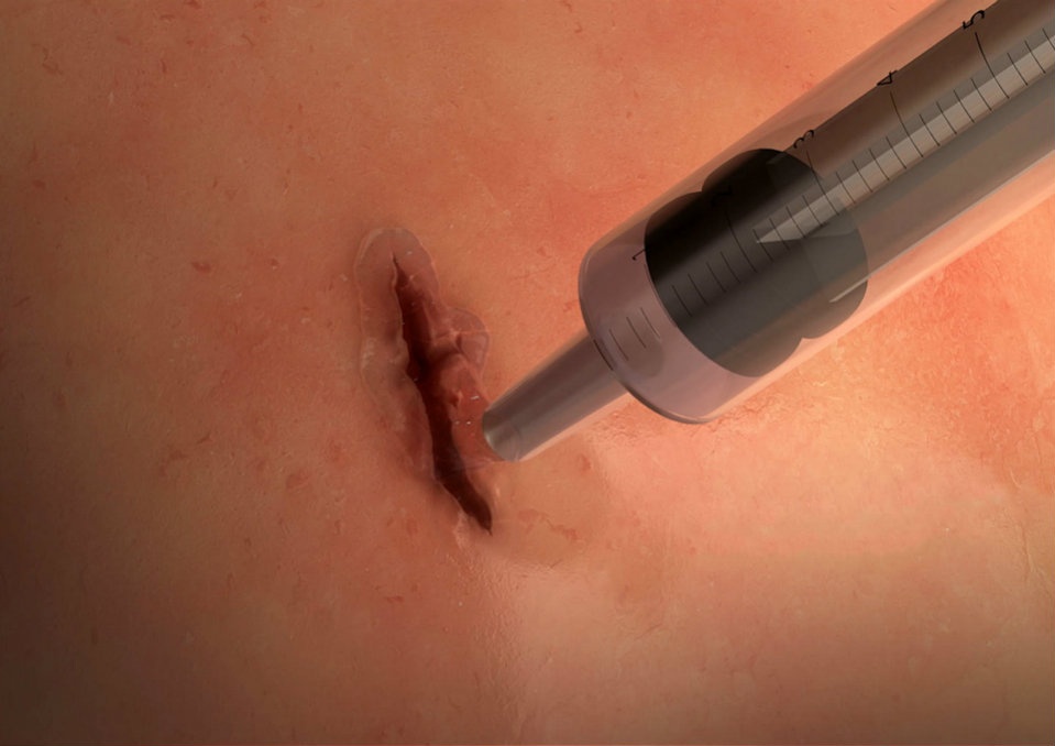 Scientists Have Developed Surgical Glue That Seals Wounds in 60 Seconds