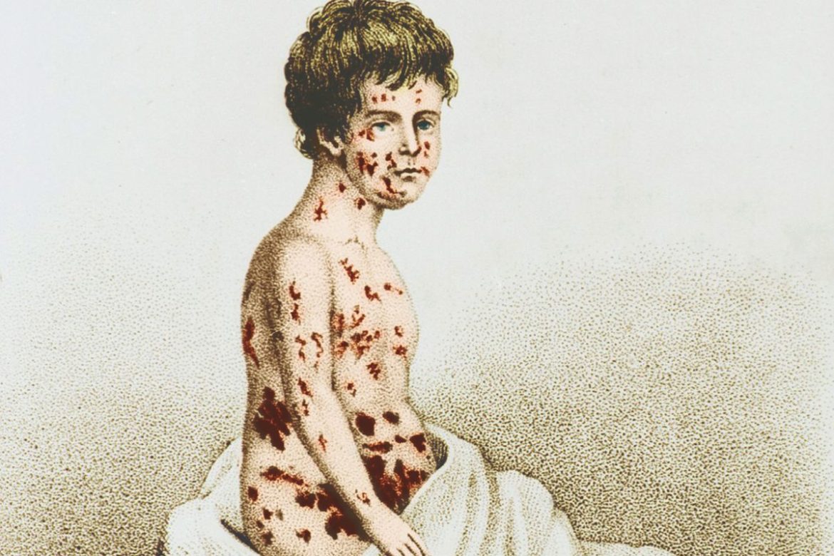 Smallpox: officially declared eradicated-this day in history