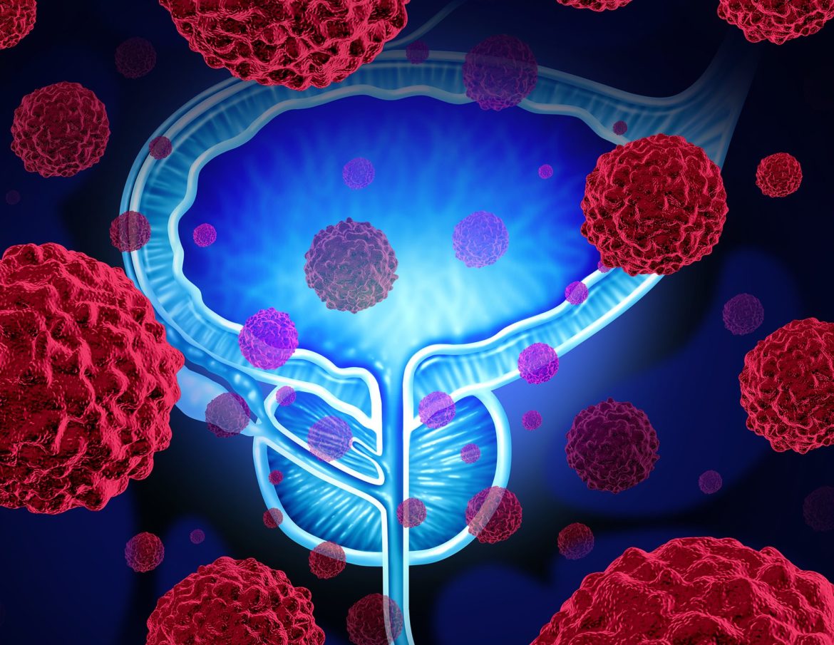 Prostate cancer: an unexpected target
