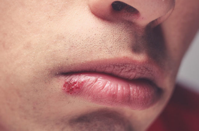 What causes those cold sore flare-ups?