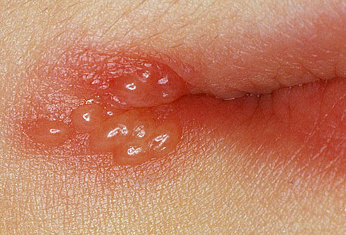 What causes those cold sore flare-ups?, learn more from News Without Politics, best non political  health and wellness news, unbiased news source, NWP