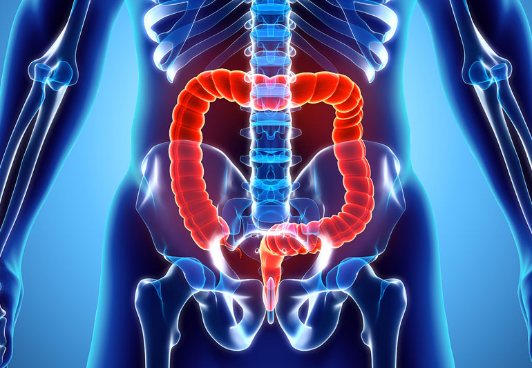 Reduce the odds of getting colon cancer: how?