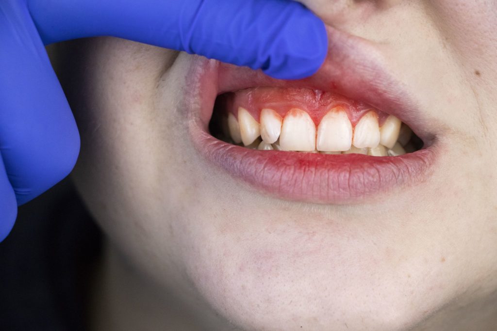 COVID-19 patients with gum disease at greater risk, learn more from News Without Politics, non political health news, dentistry, dental health, periodontitis