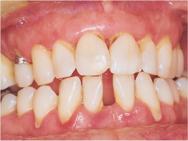 COVID-19 patients with gum disease at greater risk