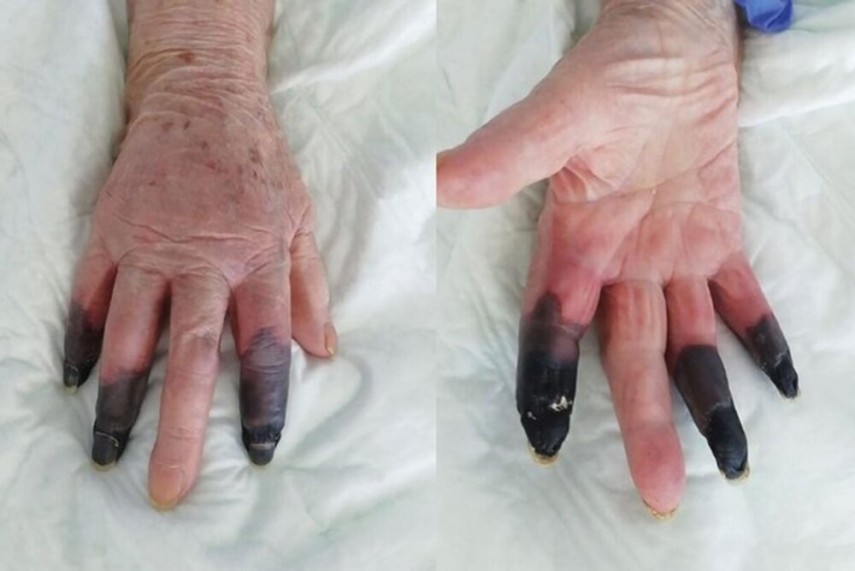 Woman with COVID-19 gets gangrene in fingers