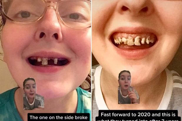 Soda addiction caused woman to lose all her top teeth, follow News Without Politics, NWP, dental care, health and wellness, most credible and interesting news stories