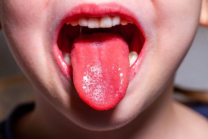 ‘Strawberry Tongue’ in girl with strep throat
