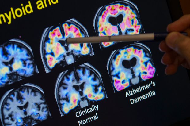 Alzheimer's brain cells nonpolitical news