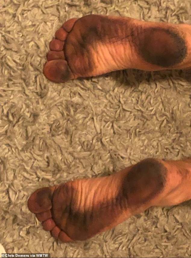 What's staining people's feet at beaches? , stay updated with no bias news , follow News Without Politics daily, Millions of Microscopic Fly Carcasses Left Dark Stains on People’s Feet at New England Beaches