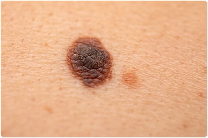 Health officials warn over melanoma as summer heats up!