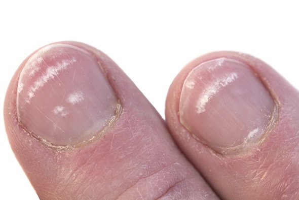 What do white spots on your nails actually mean?