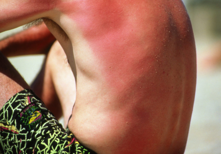 How Long Does a Sunburn Last and Is There Any Way to Make It Heal Faster?